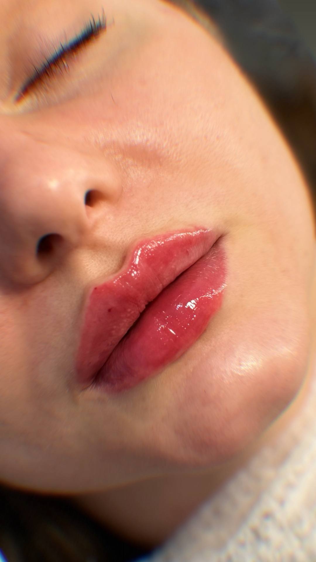 Контурная пластика губ Stylage Special Lips — фото до и после процедуры