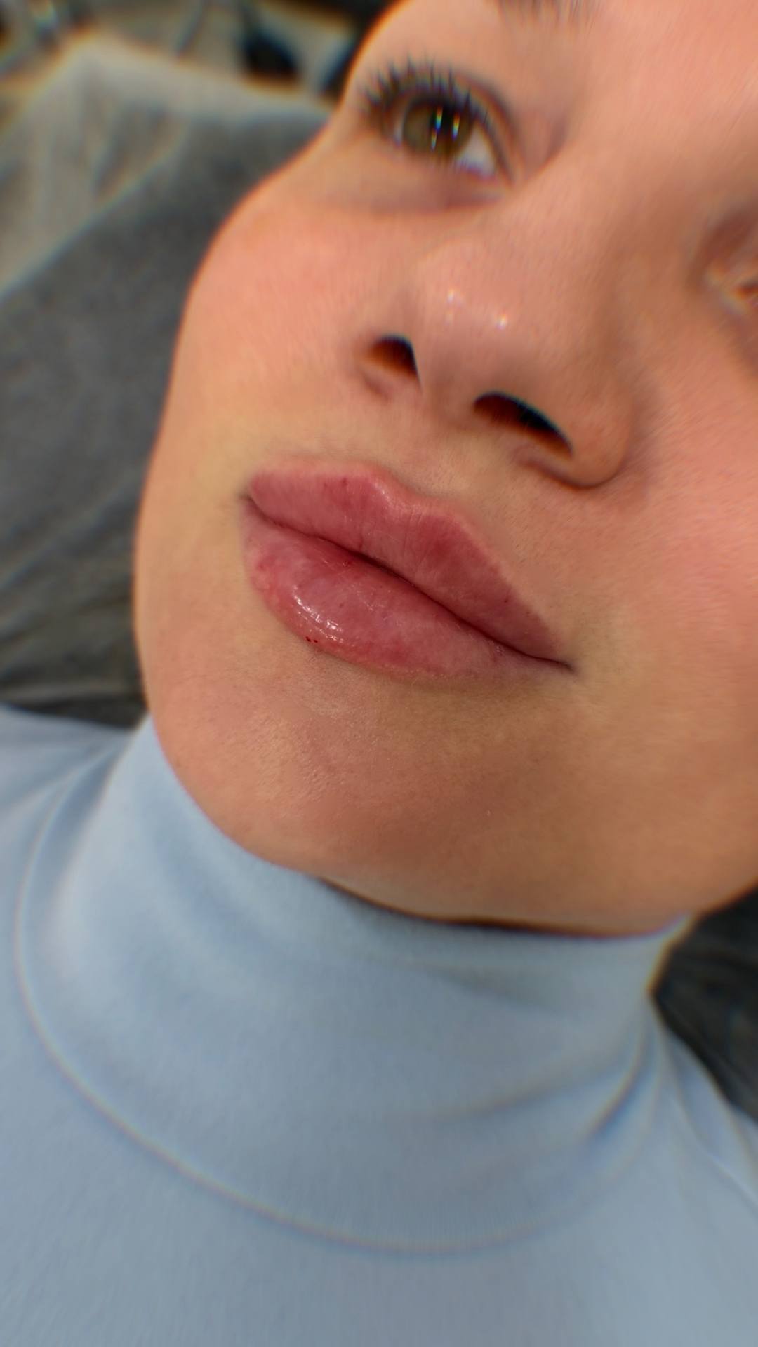 Коррекция фигуры липолитиками Lipo Long — скульптура тела, фото до и после